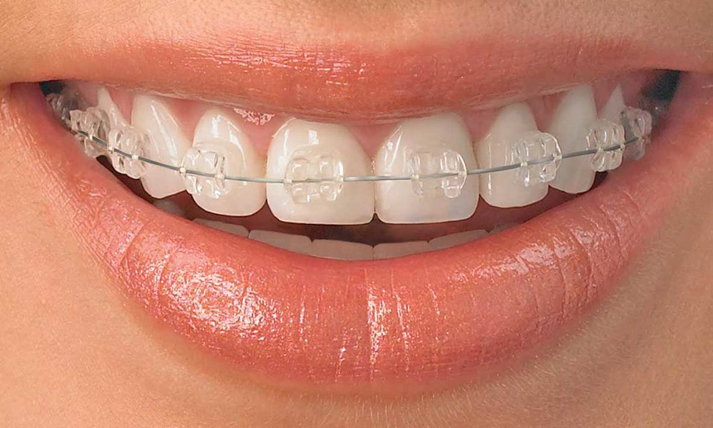 Clear-Braces-star dental