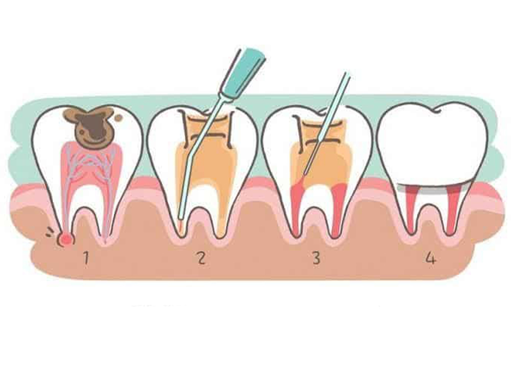Root Canal Treatment_stardental