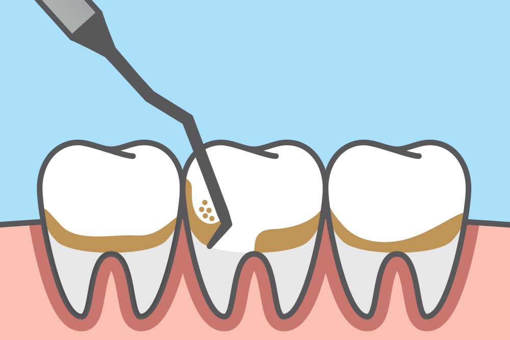 Scaling-and-Root-Planing-Treating-Gum-Disease-in-Northwest-.jpg