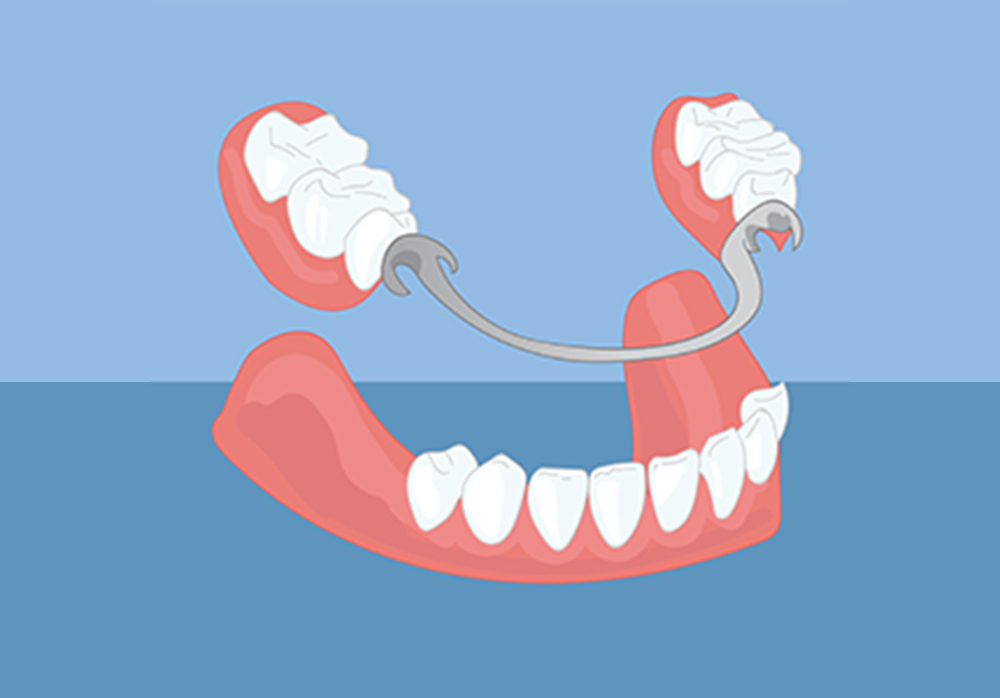 Partial Denture_stardental