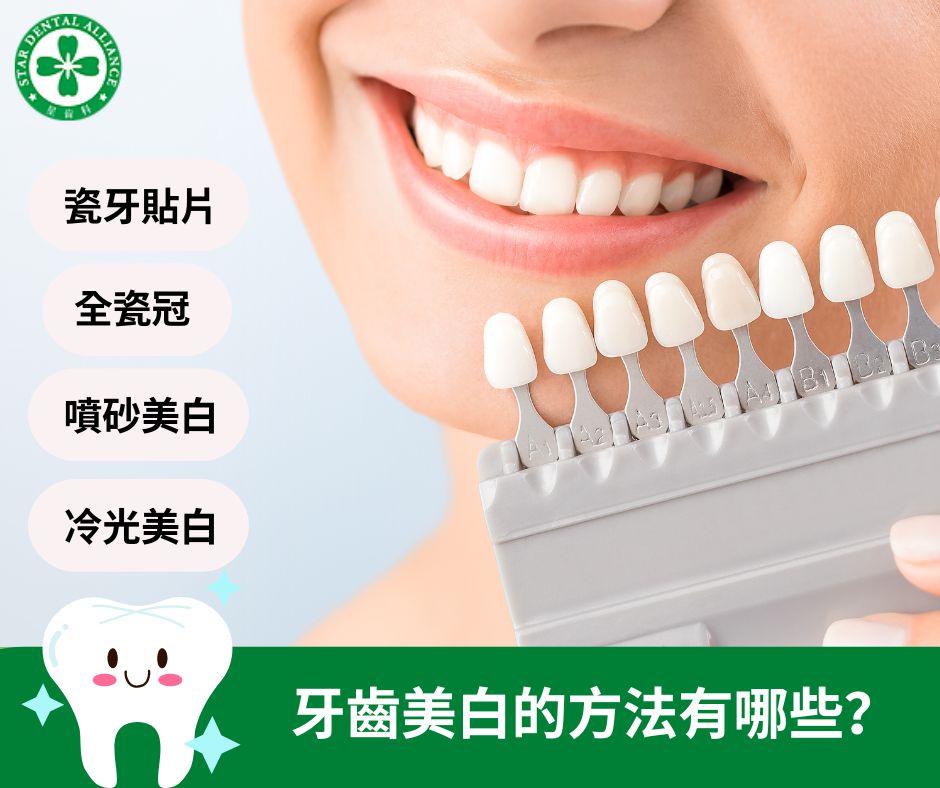 牙齒美白方法_Stardental