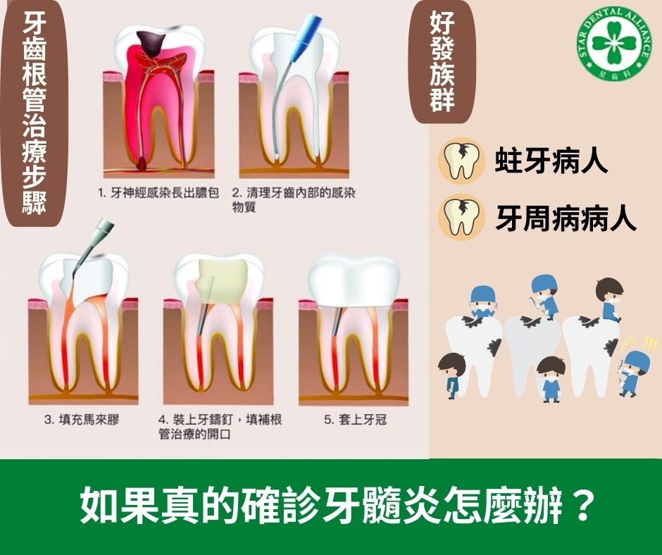 如果確診牙髓炎怎麼辦_Stardental