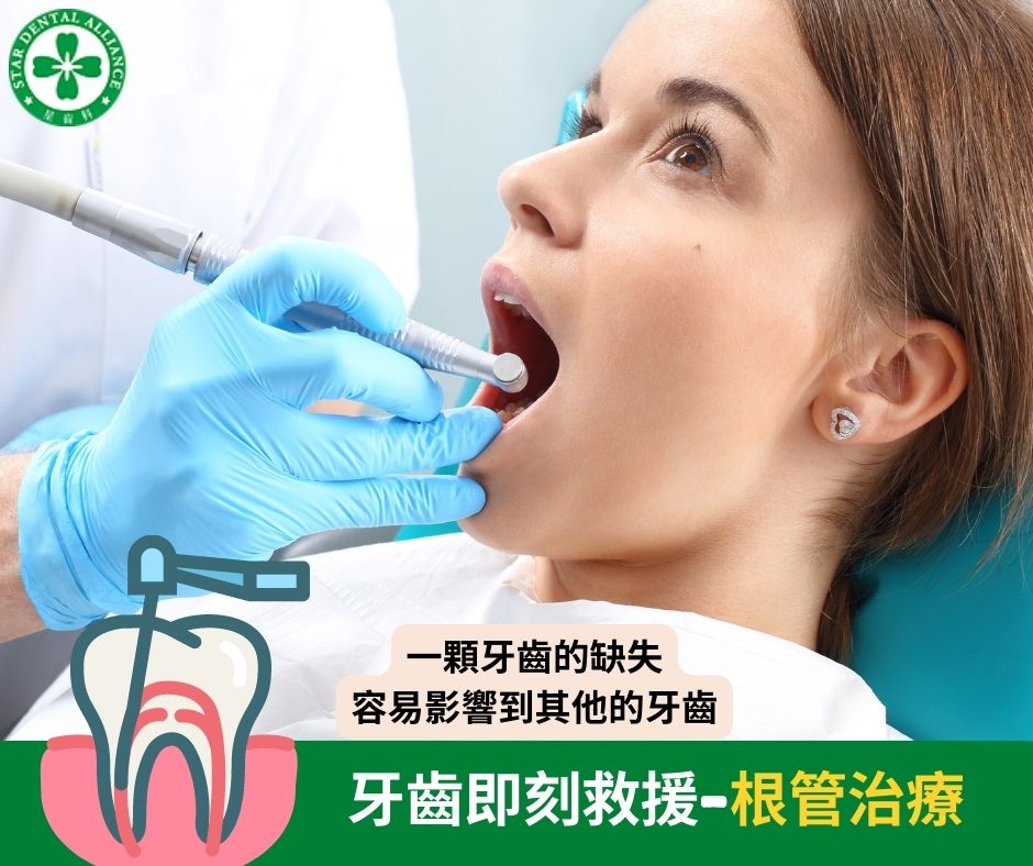 牙齒即刻救援-根管治療 -Stardental