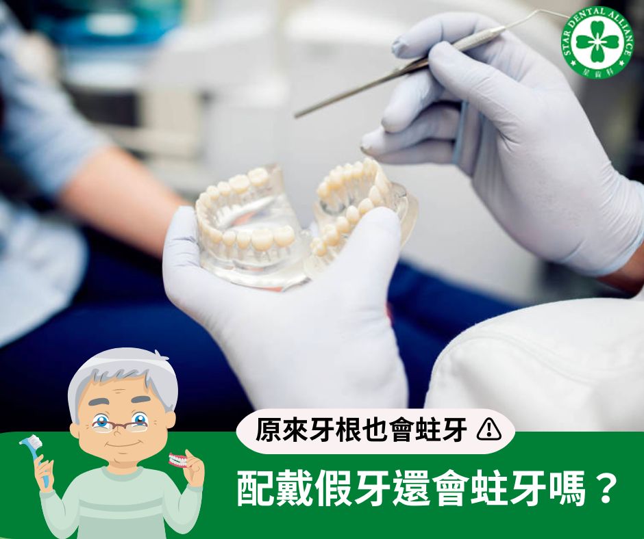 配戴假牙還會蛀牙嗎-原來牙根也會蛀牙_Stardental