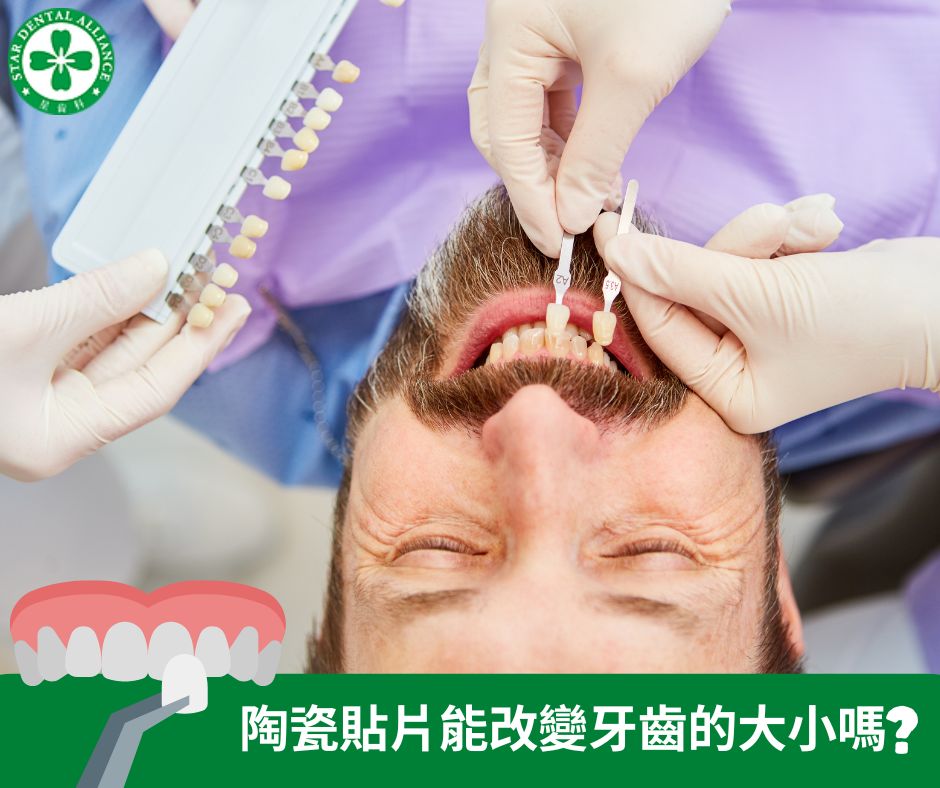 陶瓷貼片能改變牙齒的大小嗎_Stardental