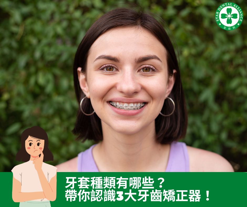 牙套種類有哪些？帶你認識4大牙齒矯_Stardental