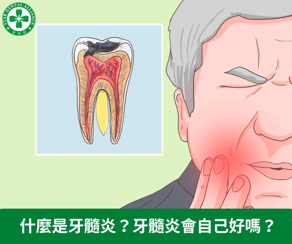 什麼是牙髓炎_牙髓炎會自己好嗎？Stardental