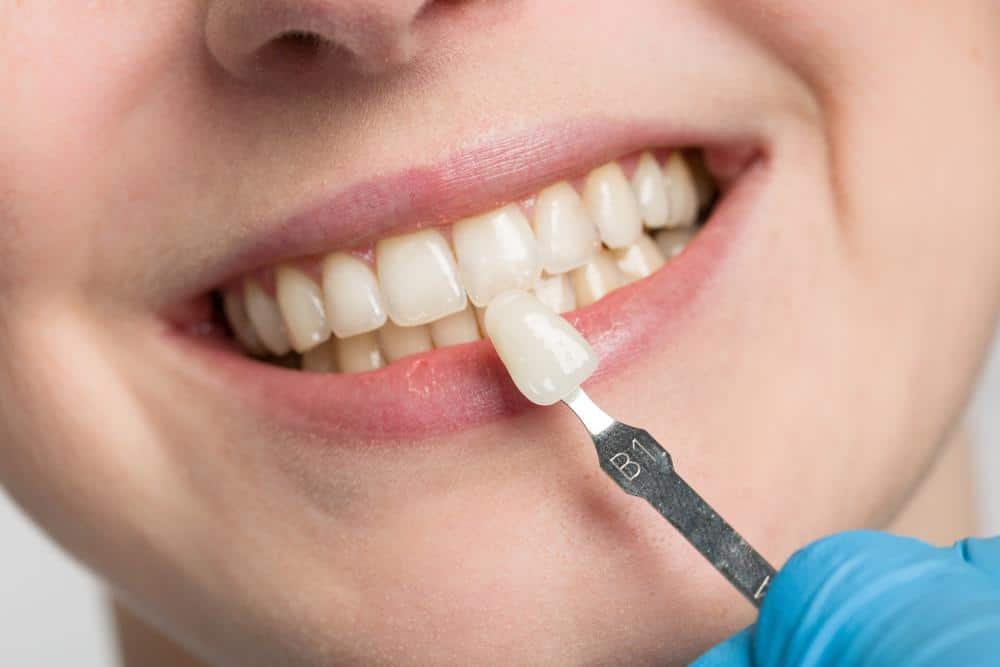 牙齒斷裂、牙齒有缺損，可以用陶瓷貼片修復嗎？-Stardental