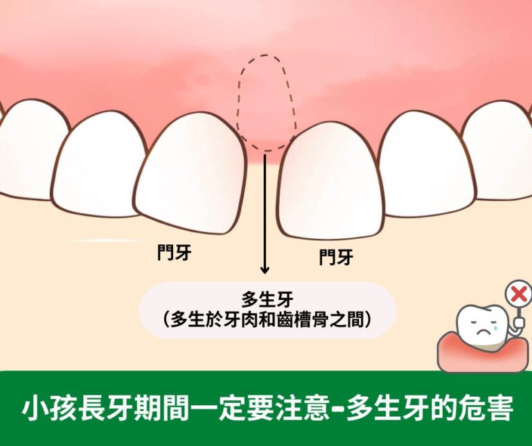 小孩長牙期間一定要注意 ​ 多生牙的危害 Stardental