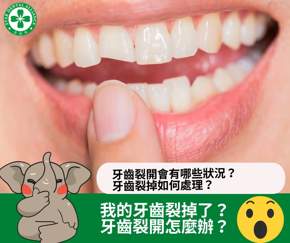 牙齒裂開怎麼辦_Stardental