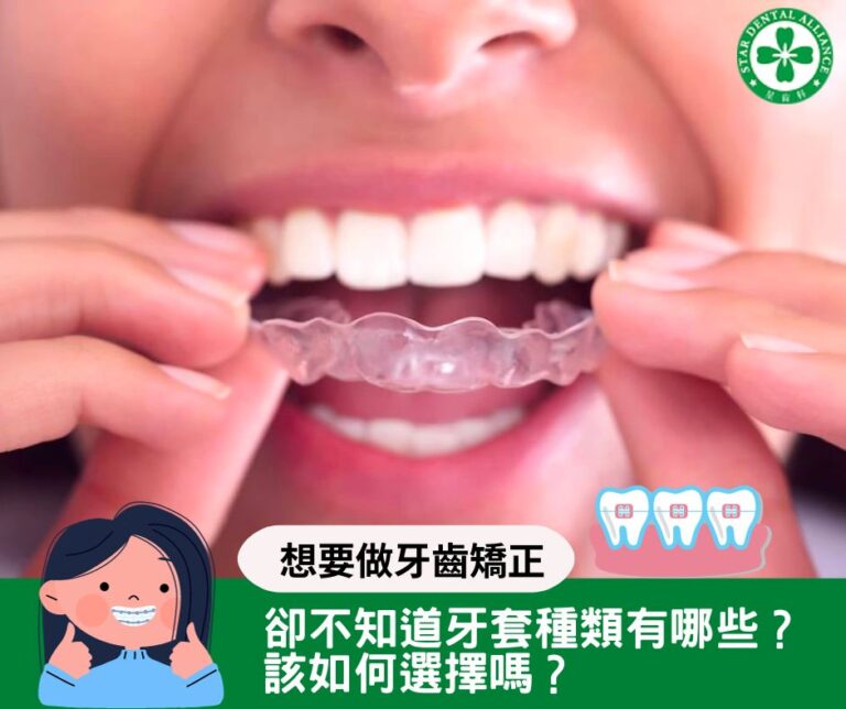 想要做牙齒矯正，卻不知道牙套種類有哪些、該如何選擇嗎？_Stardental